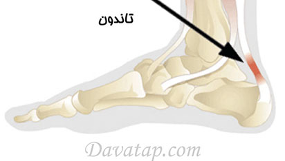 تاندون چیست