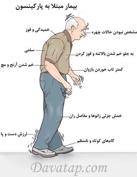 علائم پارکینسون