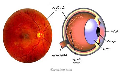 چشم (دژنراسیون ماکولا)