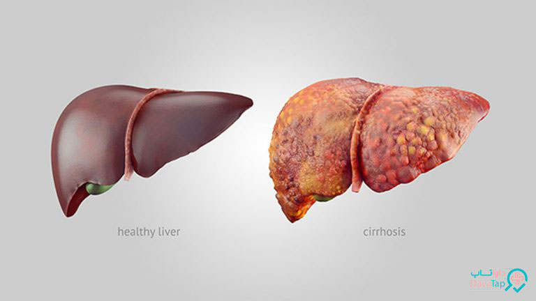 کبد سالم و ناسالم