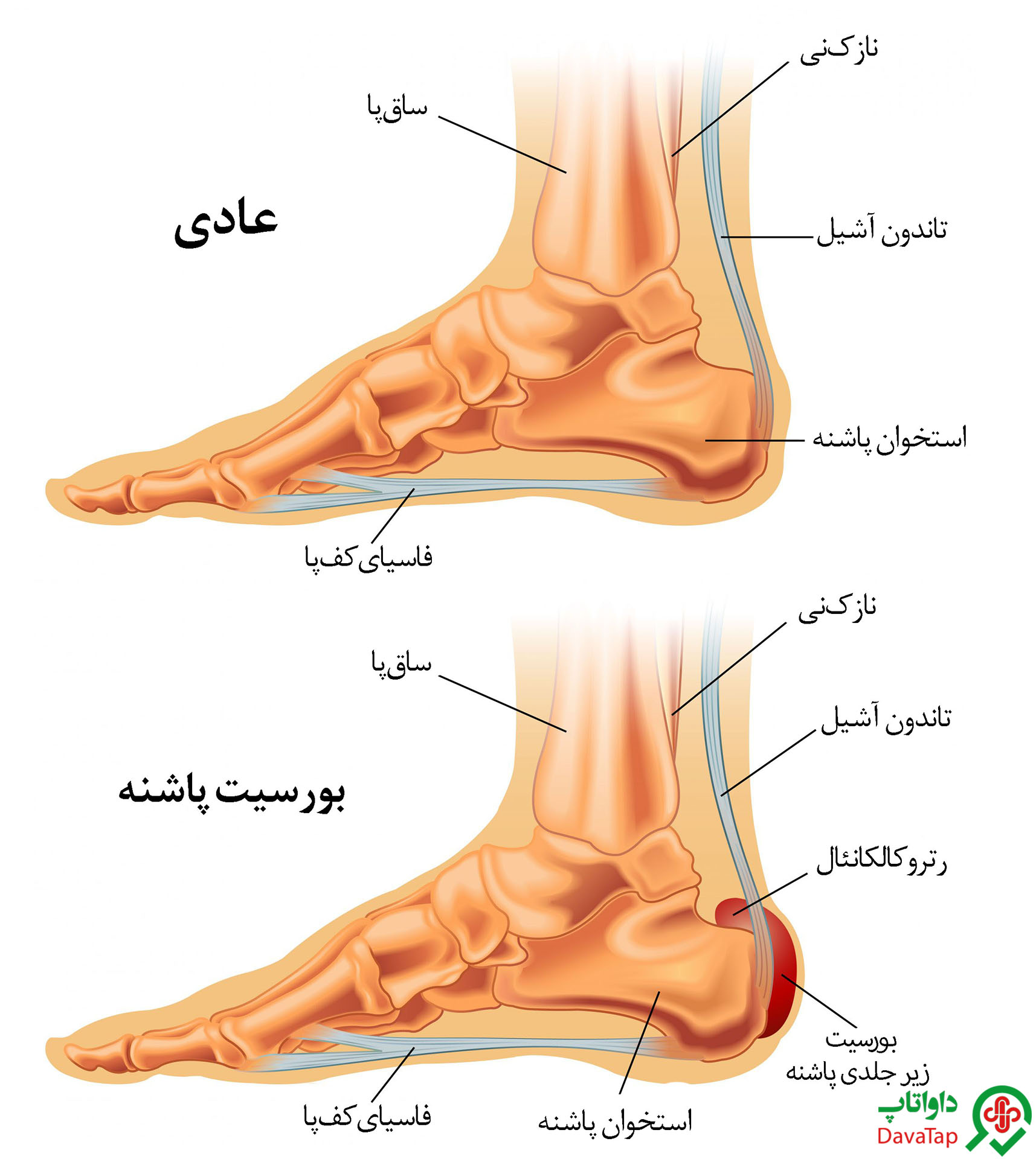 بورسیت پاشنه