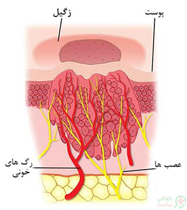 انواع زگیل