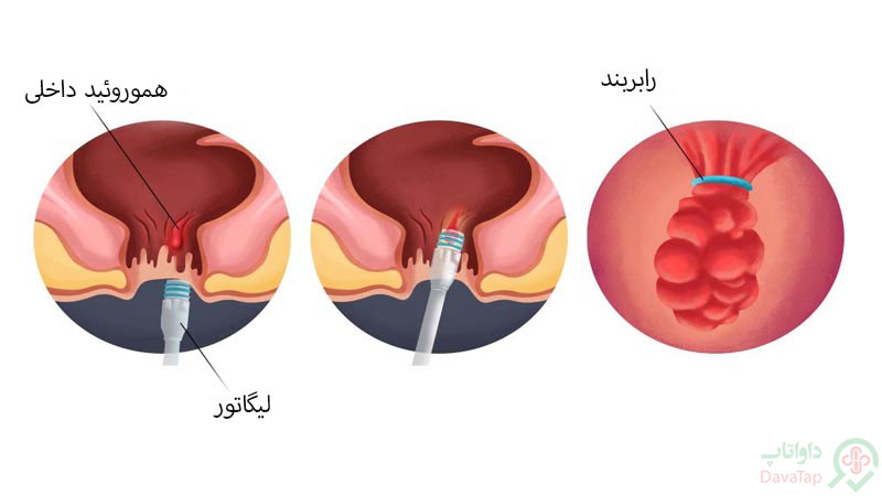 درمان بواسیر