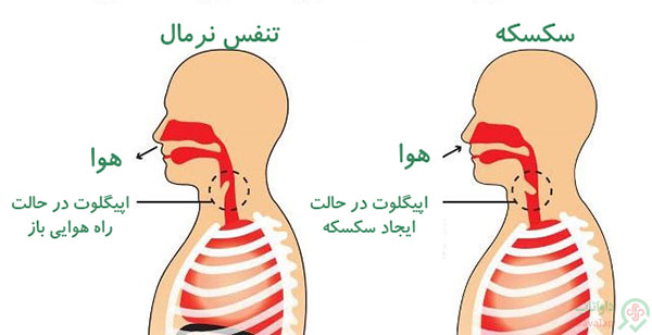 سکسکه و تنفس نرمال