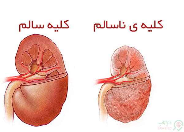 نارسایی کلیه